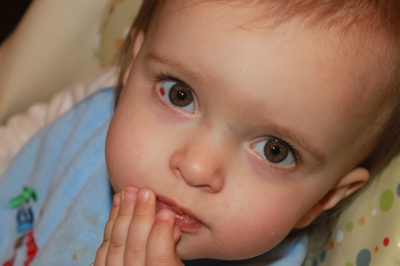 bloodshot eye??? BabyCenter